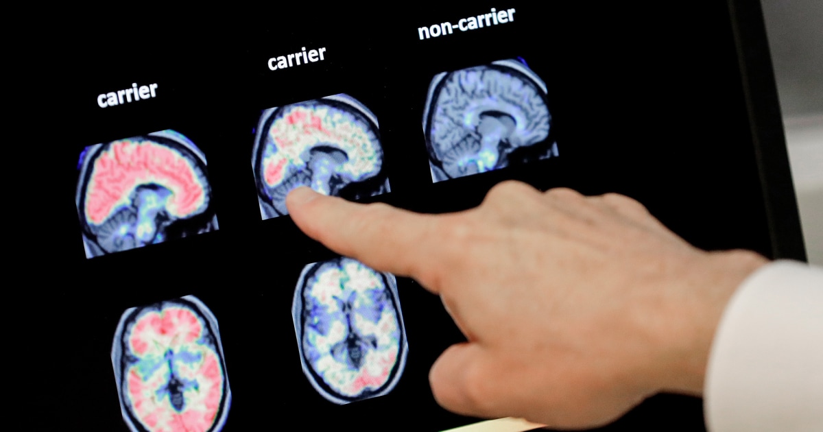 Exames de sangue para Alzheimer podem estar chegando ao consultório do seu médico. Aqui está o que você precisa saber