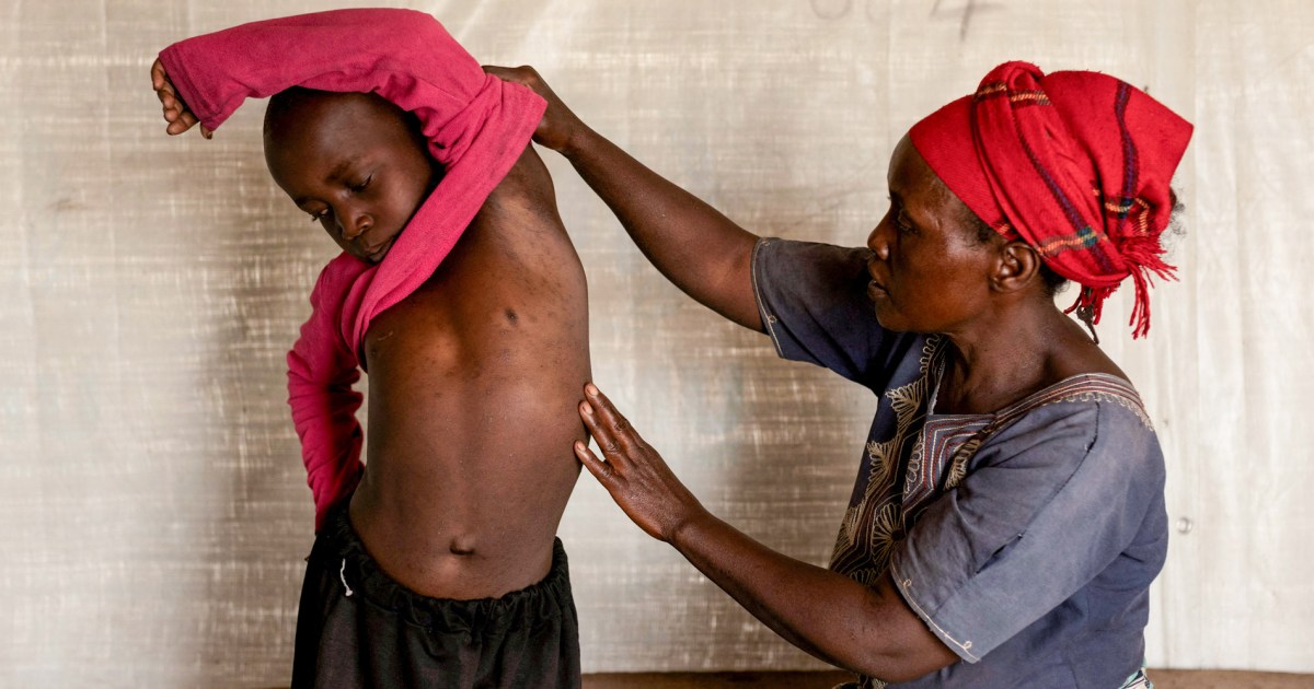 À medida que a cepa mais mortal do mpox se espalha, a OMS e o CDC consideram alertas mais fortes